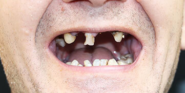 Denture Dentistry