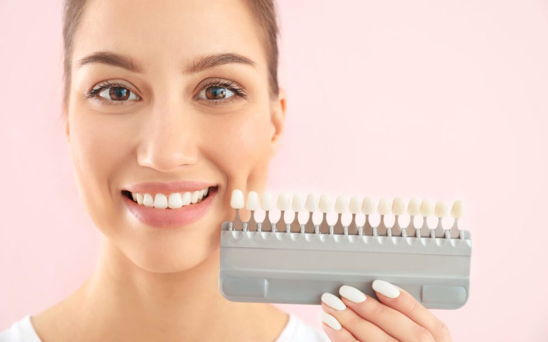 What are Dental Veneers? A Comprehensive Guide for a Radiant Smile