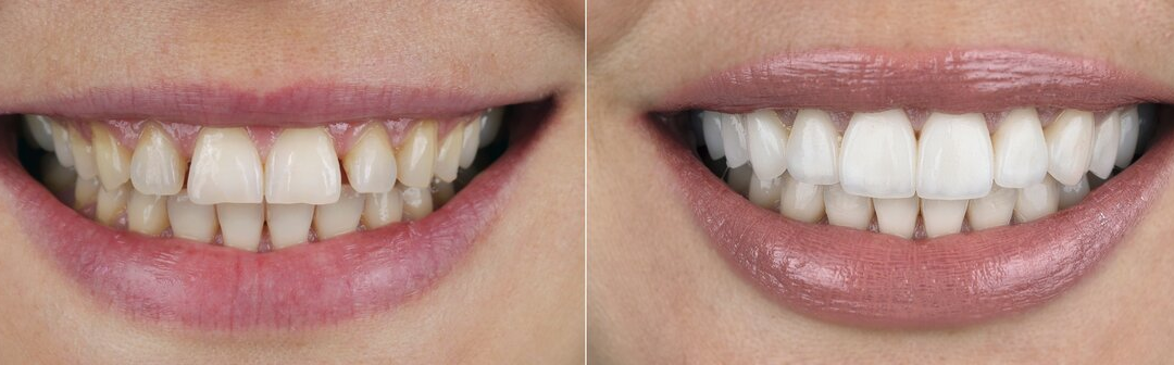 Porcelain Veneers Before and After: Photographic Proof